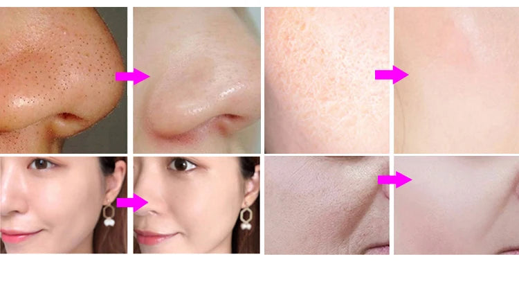 In Smart Ice Blue Hydra Oxyge Dermabrasion Facial